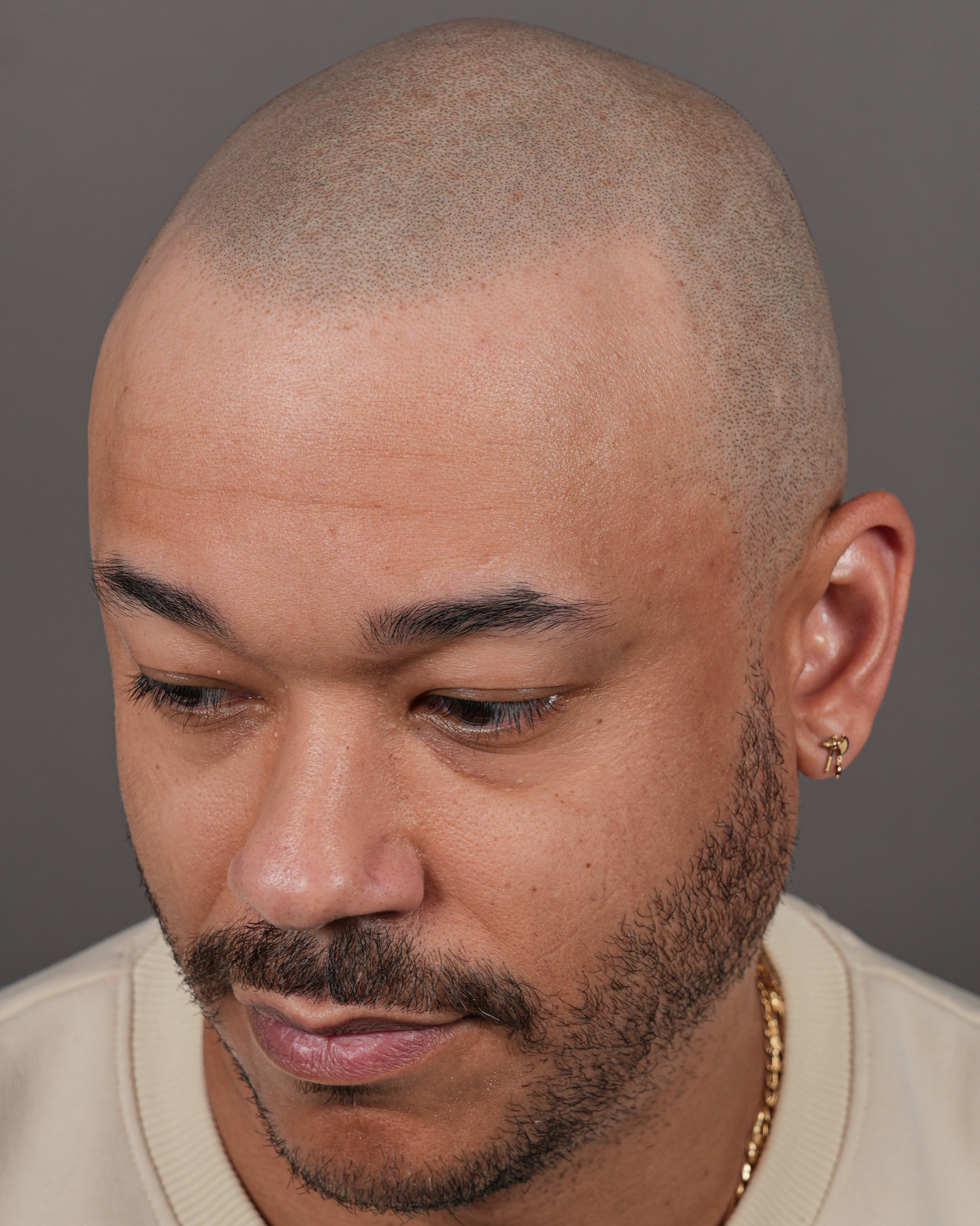 Close detail of SMP hairline and skin texture