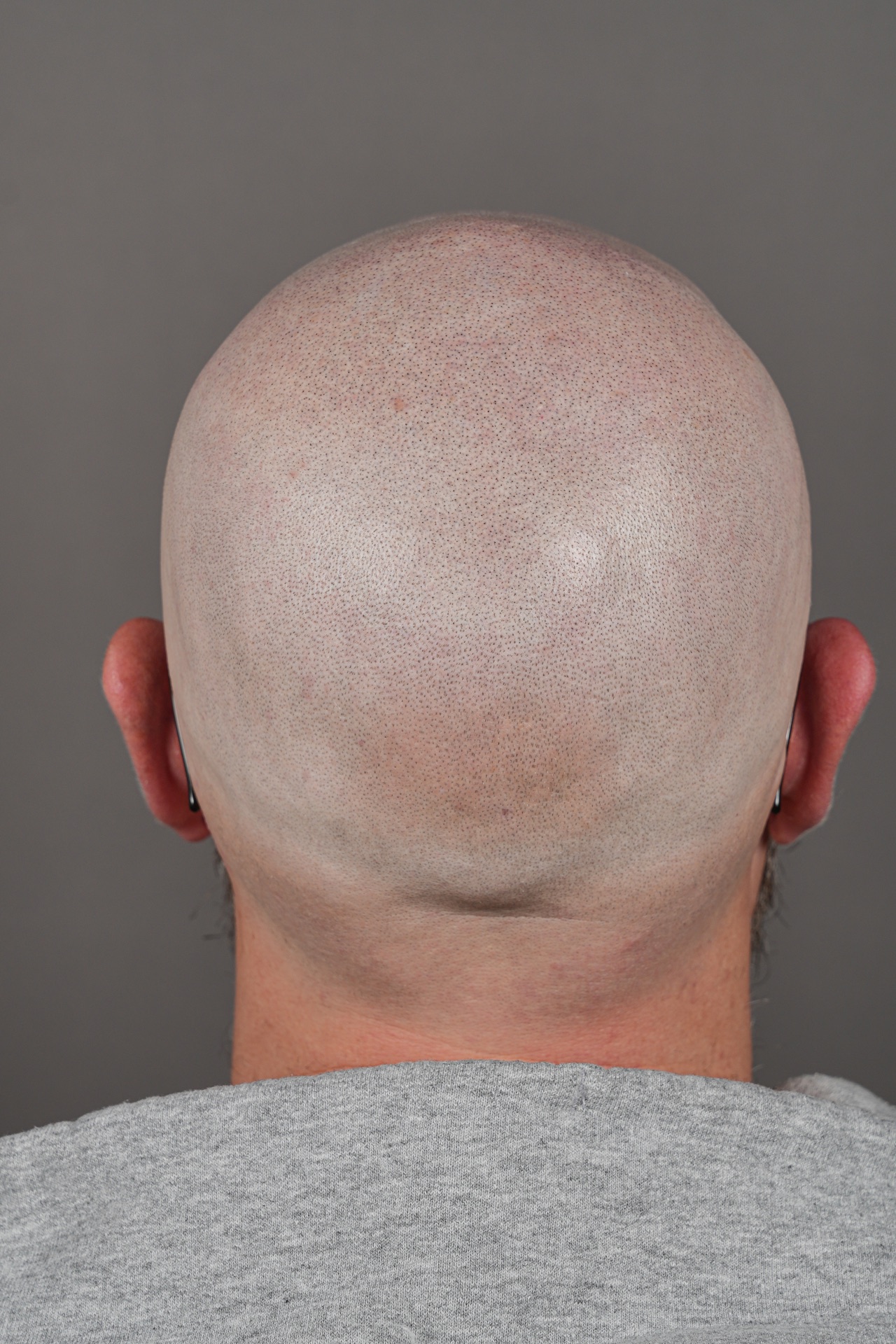 SMP density through the crown, rear view